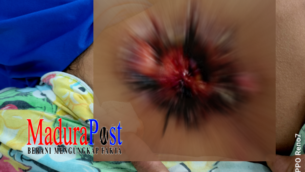 Diduga Jadi Korban Malpraktik Dokter Palsu, Warga Pasongsongan Alami Luka Borok di Punggung
